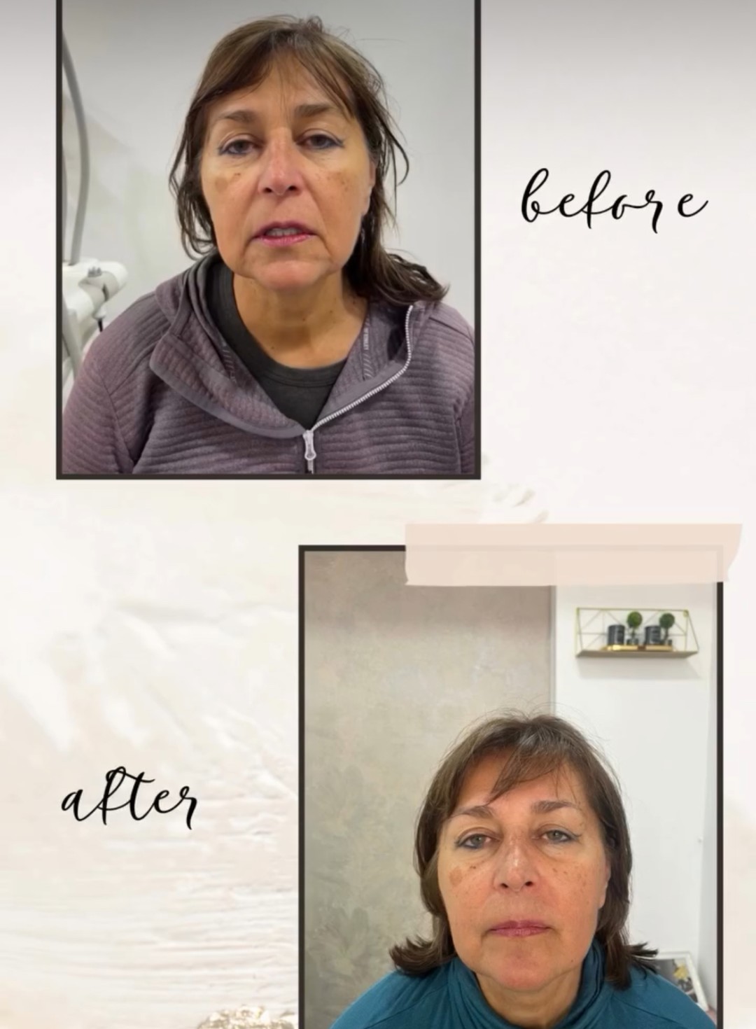 VelaShape #sarajevo Tretman lica RF tretman - lice + vrata