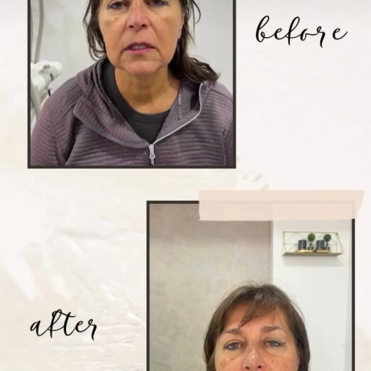 VelaShape #sarajevo Tretman lica RF tretman - lice + vrata Radiofrekvencija lica