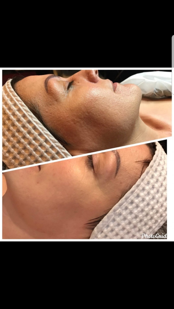 Vedrana #sarajevo Tretman lica