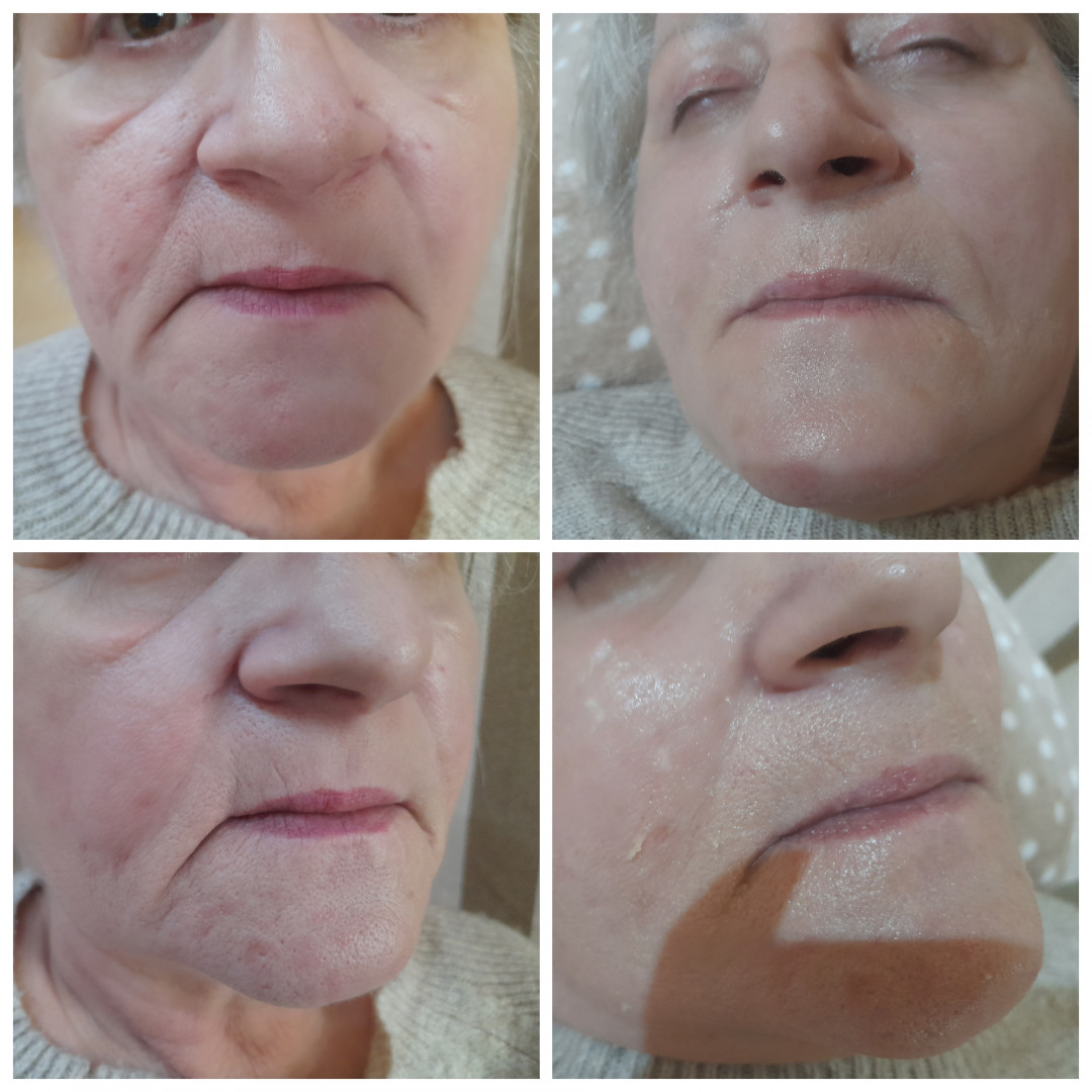 Tretman srebrnim + zlatnim nitima - lice + vrat + dekolte - Poezija ljepote, Sarajevo Tretman lica Lice Tretman lica, Sarajevo, Novo Sarajevo - Novi Grad