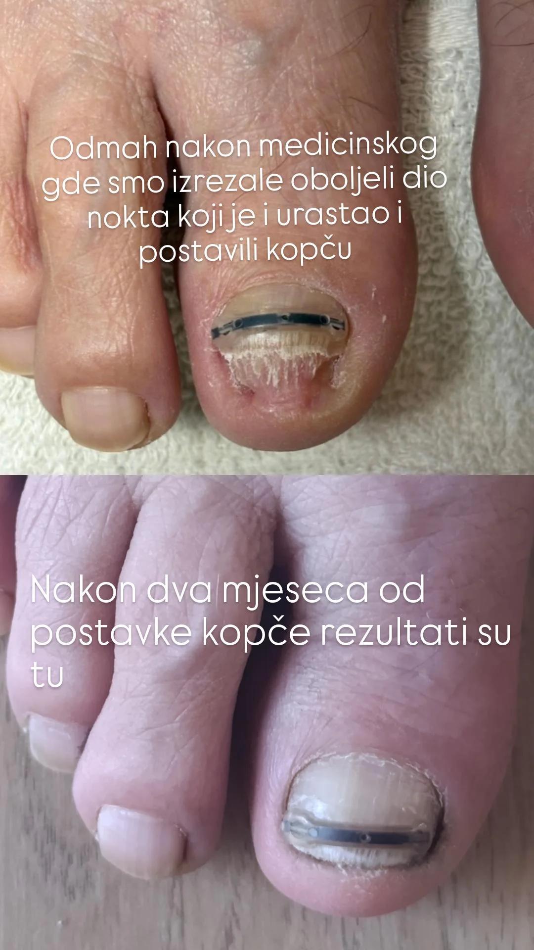 Studio Relax #kozarska-dubica Ojačavanje noktiju Medicinski pedikir sa postavkom kopče za urasli nokat