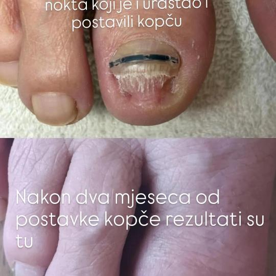 Studio Relax #kozarska-dubica Ojačavanje noktiju Medicinski pedikir sa postavkom kopče za urasli n