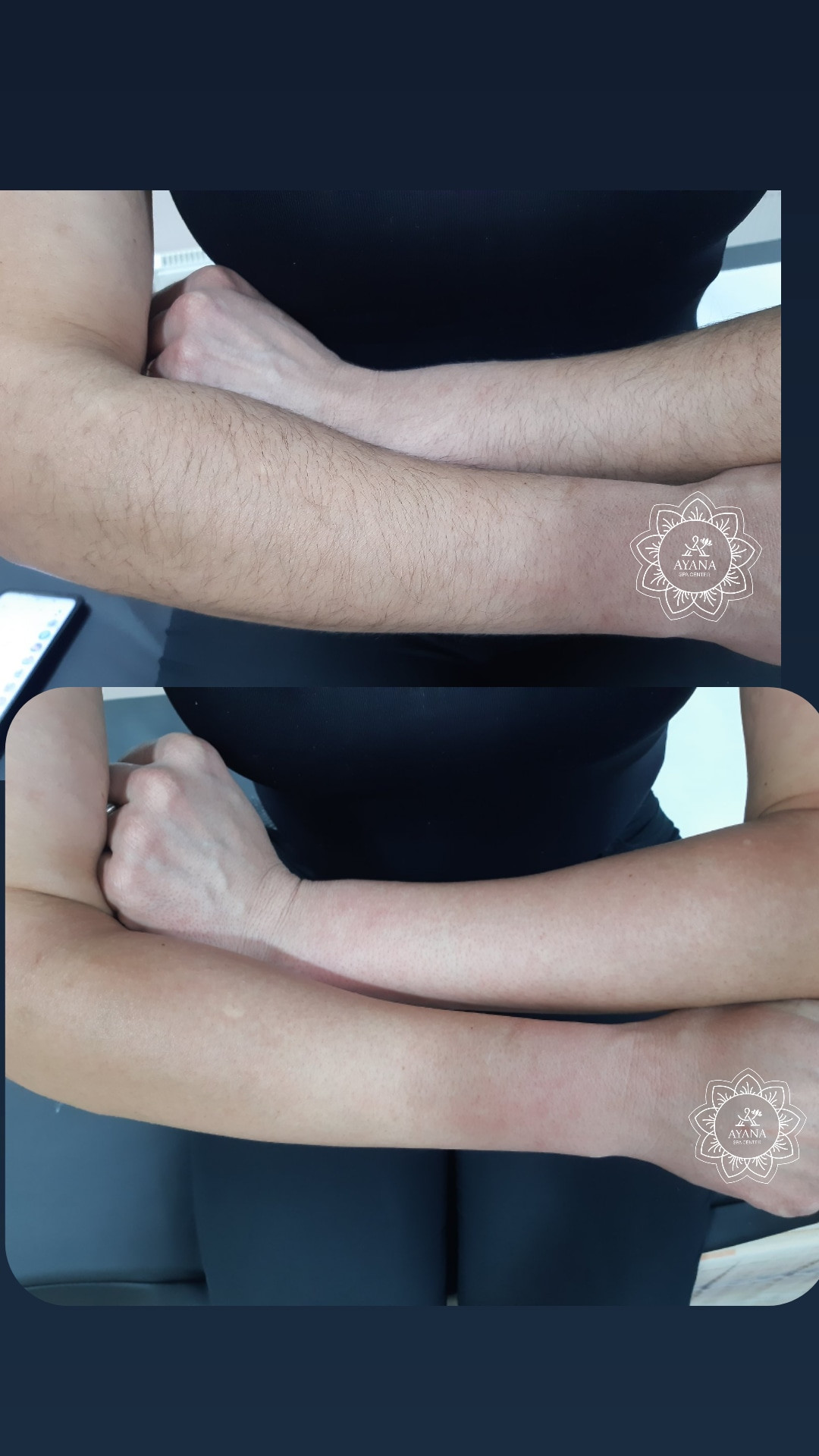 Ayana Spa #sarajevo Depilacija šećernom pastom Depilacija cijelih ruku šećernom pastom - za dame