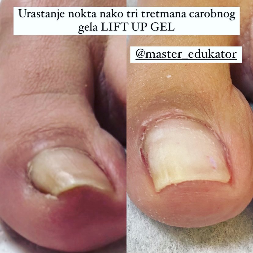 Senka #sarajevo Medicinski pedikir Obrada uraslog nokta