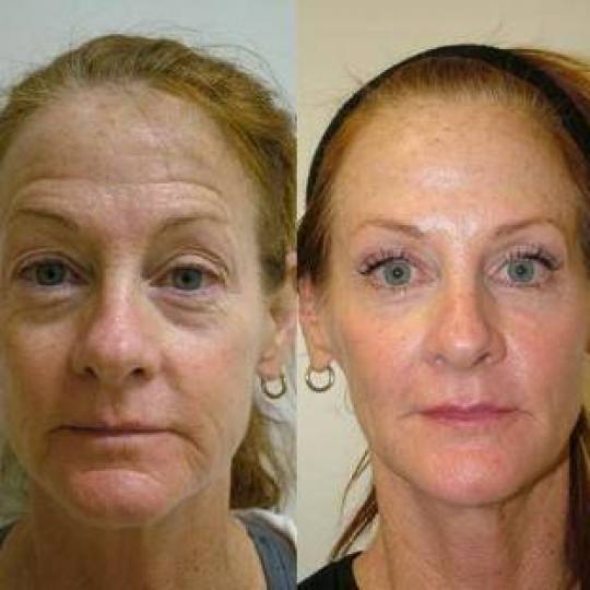 Vedrana #sarajevo Japanski Cosmo Lifting SORENSENSISTEM™


Japanski Cosmo Lifting SORENSENSISTE