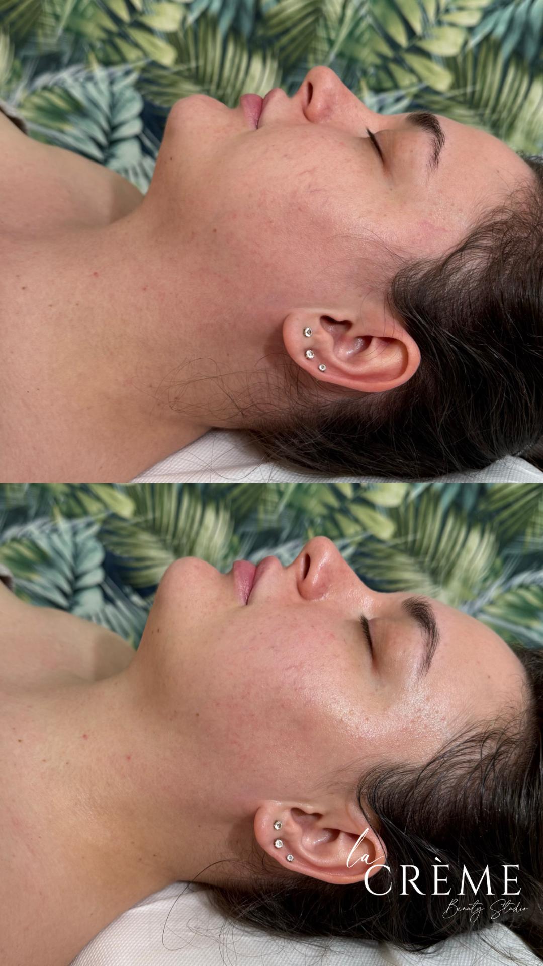 La Crème Beauty Studio #sarajevo Tretmani tijela Limfomodelovanje -Lice