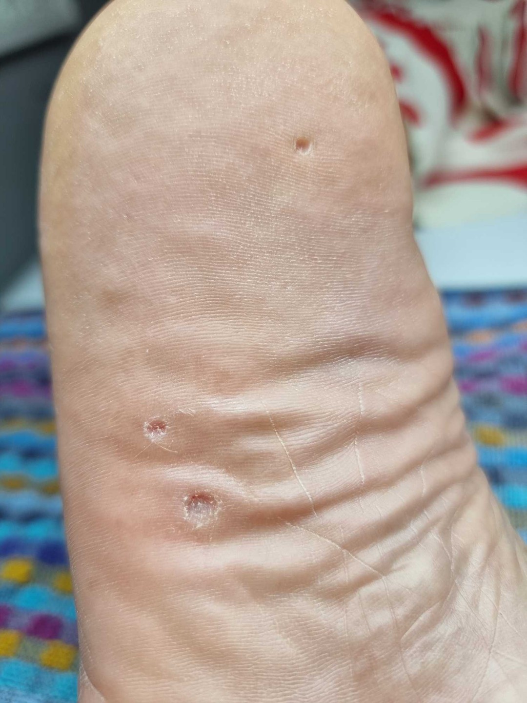 Sanpatra #zenica Medicinski pedikir Liječenje kurjih očiju / žuljeva / bradavica