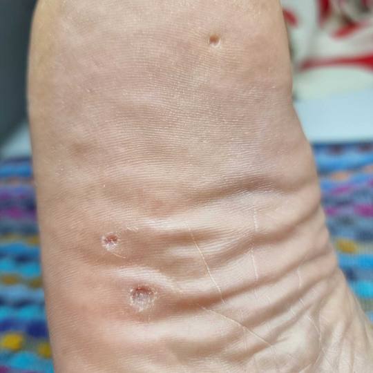 Sanpatra #zenica Medicinski pedikir Liječenje kurjih očiju / žuljeva / bradavica Medicinski tretm