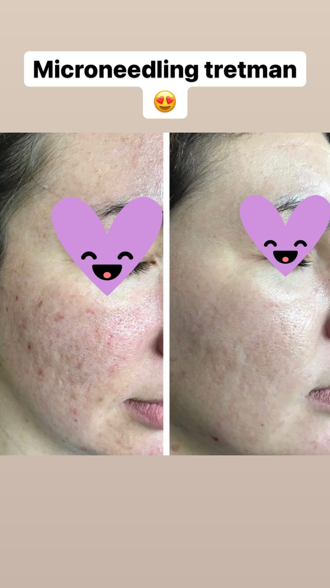 Damen #sarajevo Tretman lica Ultrazvučno čišćenje + microneedling tretman lica