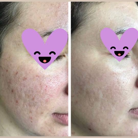 Damen #sarajevo Tretman lica Ultrazvučno čišćenje + microneedling tretman lica Efekat nakon micr