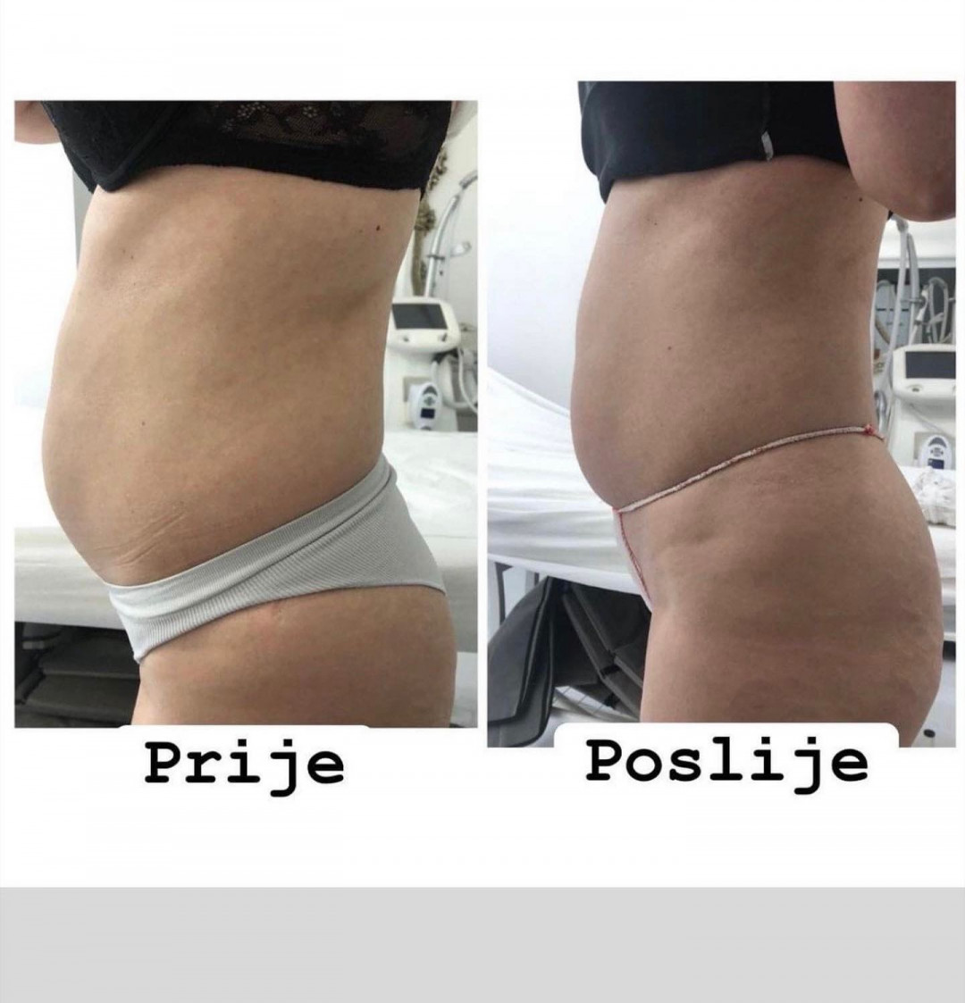 Laser Beauty Studio #visoko Tretmani tijela Topljenje masnih naslaga ultrazvukom - paket od 10 tretmana