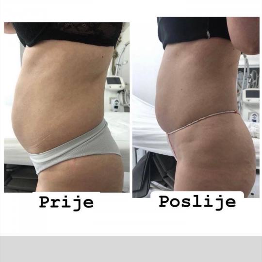 Laser Beauty Studio #visoko Tretmani tijela Topljenje masnih naslaga ultrazvukom - paket od 10 tretm