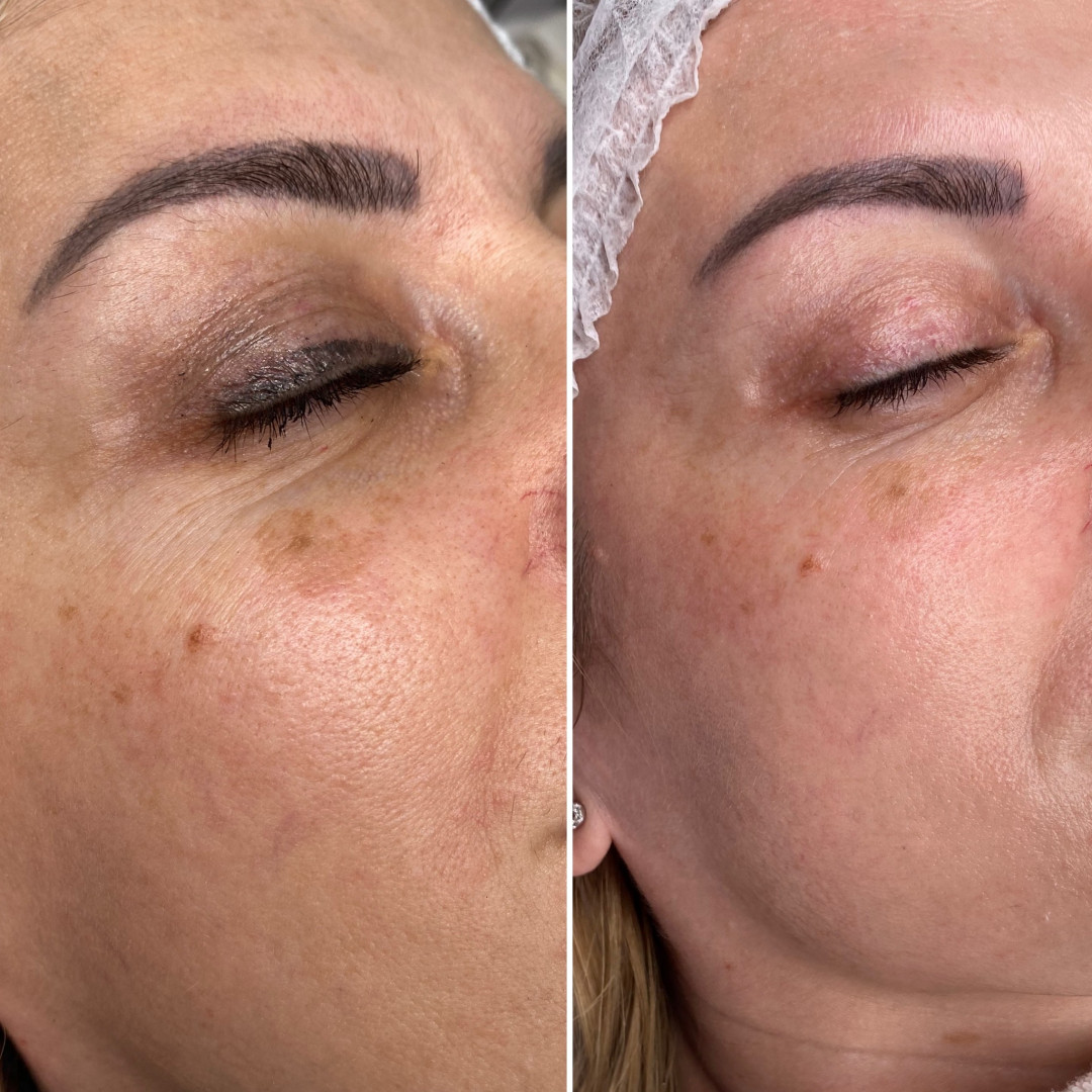 Paket tretmana za pigmentacijske fleke - Fabrika ljepote, Sarajevo Tretmani tijela Tijelo Tretmani tijela, Sarajevo, Istočno Sarajevo