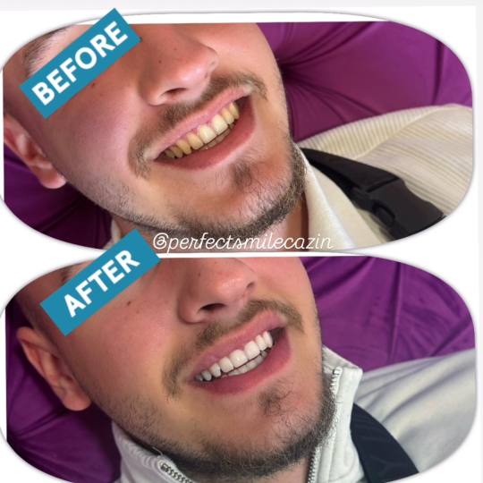 Perfect Smile, izbjeljivanje zuba Cazin usluga