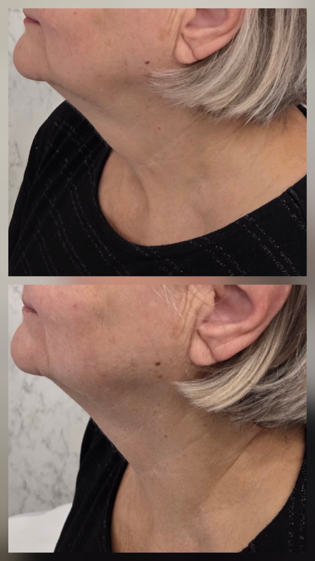 Angels Beauty - Banja Luka #banjaluka Tretman lica HIFU tretman - vrata