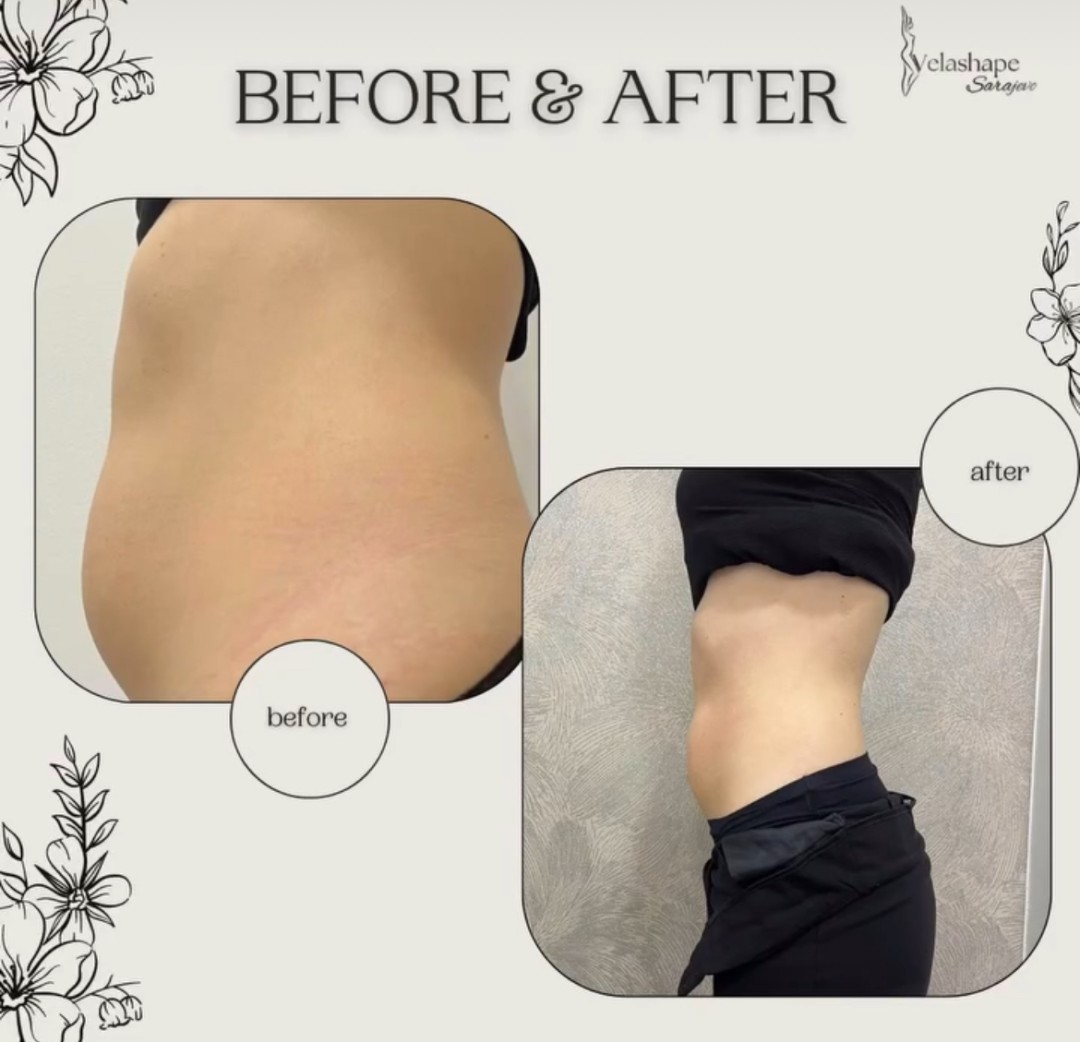 VelaShape #sarajevo Air brush potamnjivanje kože Velashape + RF tretman - stomak