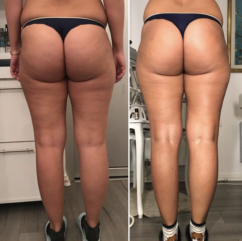 Skockica paket - maderoterapija noge + gluteus - Fabrika ljepote, Sarajevo Anticelulit masaža Masaža Anticelulit masaža, Sarajevo, Istočno Sarajevo