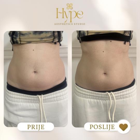 Hype Aesthetics Studio #sarajevo HIFU tretman HIFU 7D - jedna regija na tijelu HIFU tretman za stoma