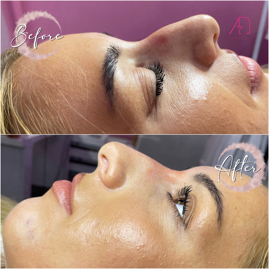 AEsthetic Bar Academy #sarajevo Hijaluronski tretmani lica