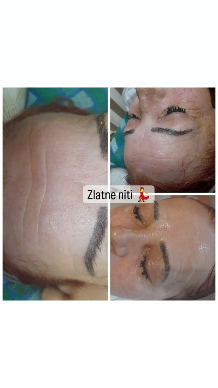 Tretman srebrnim + zlatnim nitima - lice + vrat + dekolte - Poezija ljepote, Sarajevo Tretman lica Lice Tretman lica, Sarajevo, Novo Sarajevo - Novi Grad