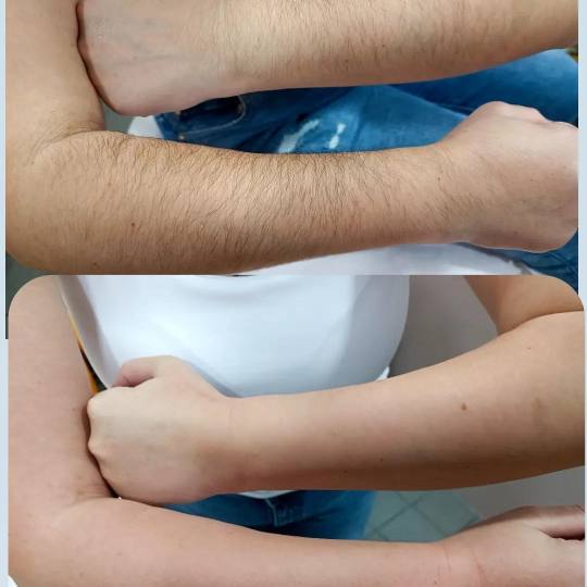 Ayana Spa #sarajevo Depilacija šećernom pastom Depilacija cijelih ruku šećernom pastom - za dame