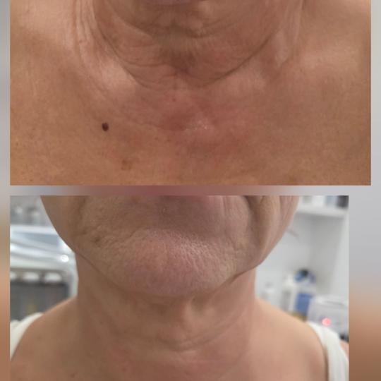 Angels Beauty - Banja Luka #banjaluka Tretman lica HIFU tretman - lica + vrata + dekoltea