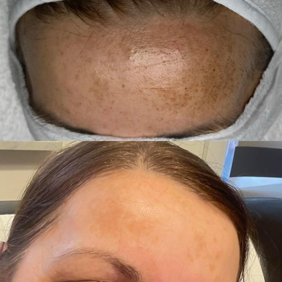 Hemijski piling - hiperpigmentacija - Hanas Skin Centar, Banja Luka Tretman lica Lice Tretman lica, Banja Luka, Centar