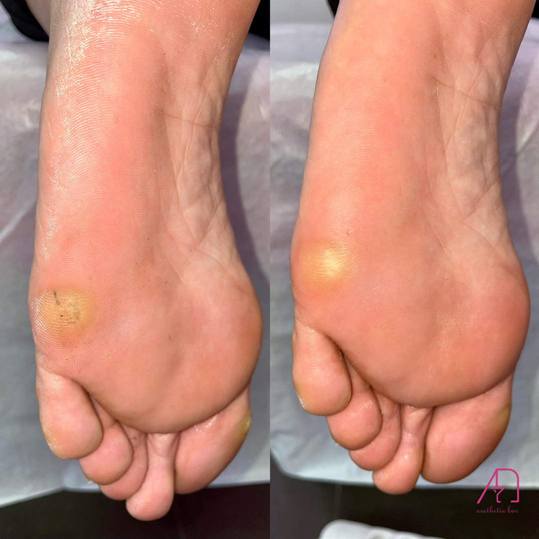 AEsthetic Bar Academy #sarajevo Estetski pedikir Ruski pedikir