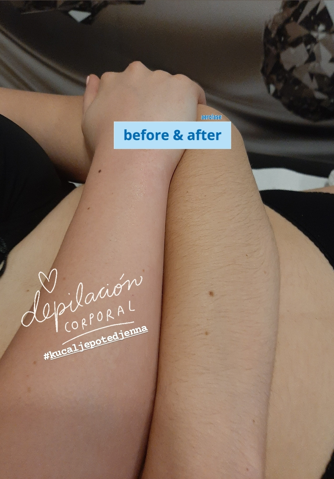 Kuća ljepote Djenna #sarajevo Depilacija šećernom pastom Depilacija ruku šećernom pastom