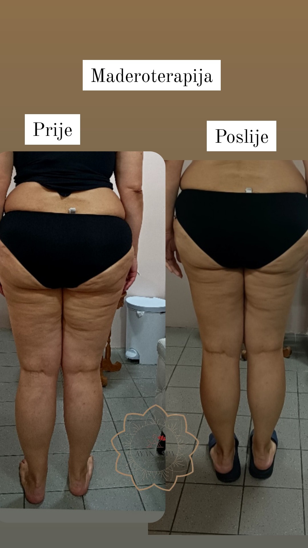 Ayana Spa #sarajevo Anticelulit masaža Maderoterapija nogu i stražnjice