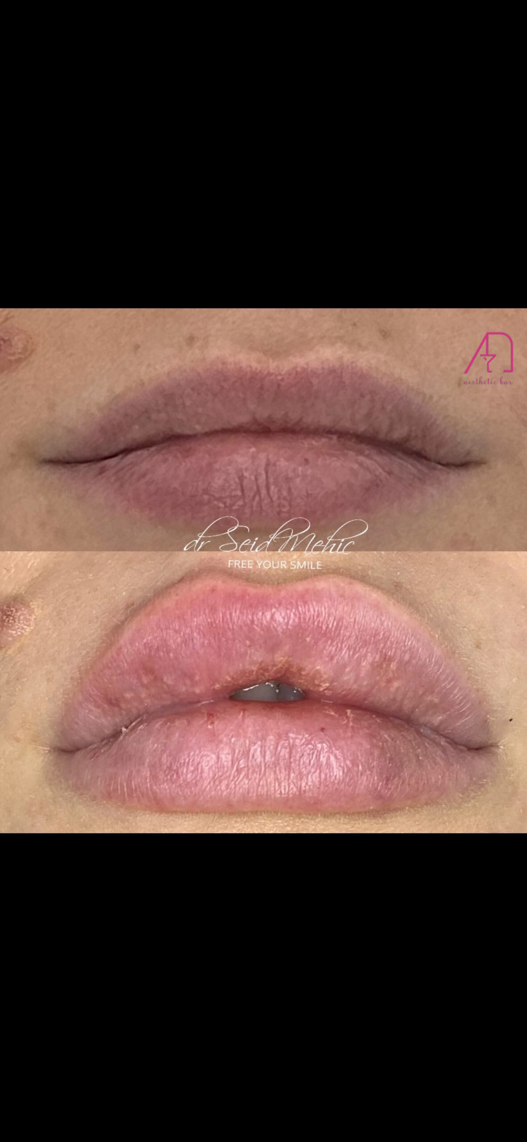 AEsthetic Bar Academy #sarajevo Hijaluronski tretmani lica