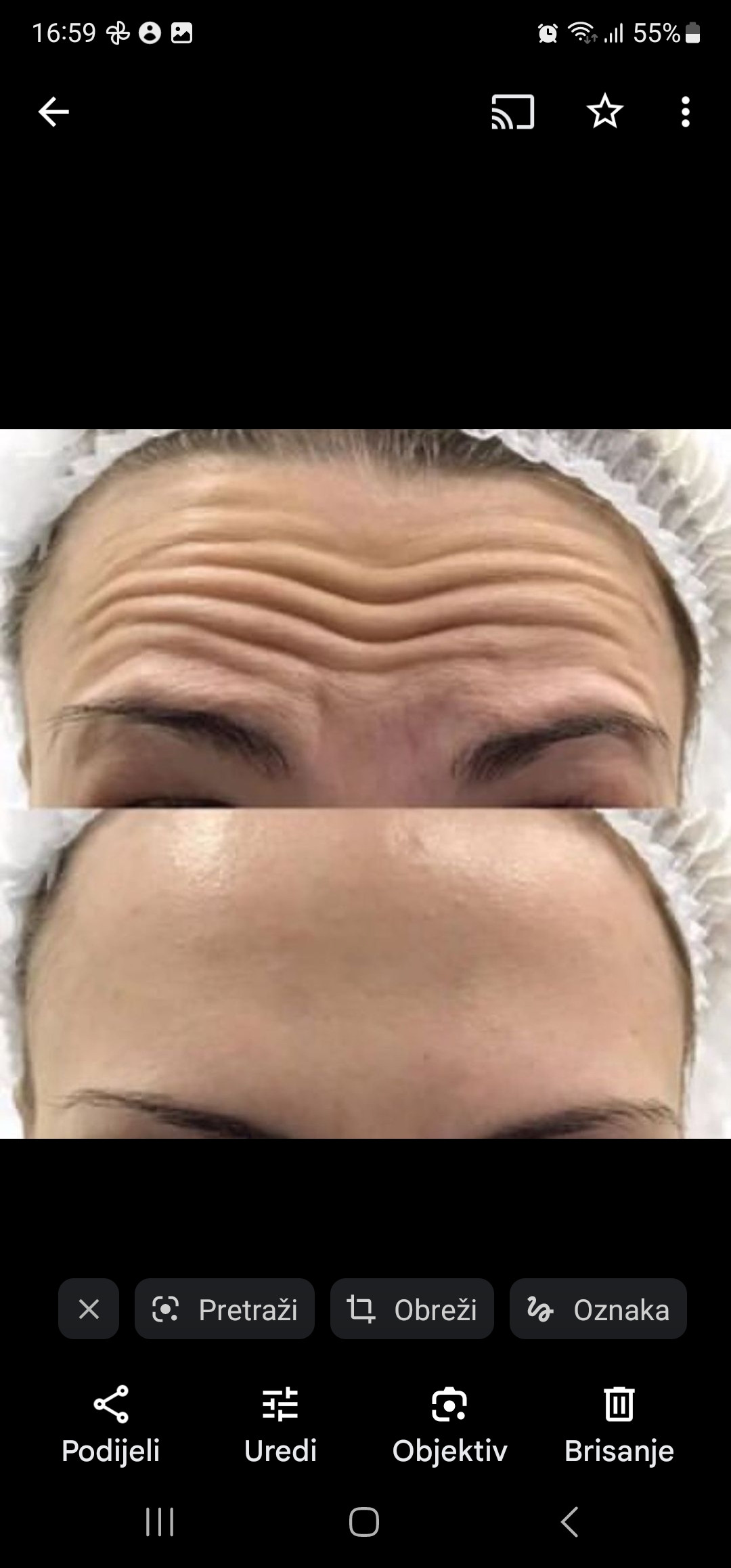 Sandra #visoko Tretman lica HIFU - regija oko očiju i cela