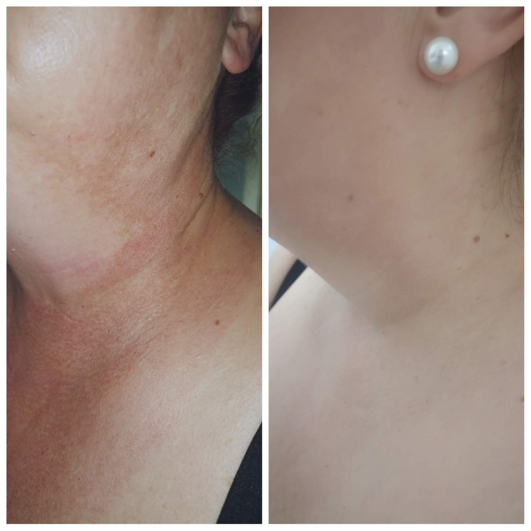 Elis Esthetic Studio #sarajevo Tretman lica