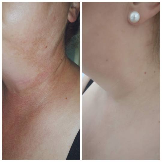 Elis Esthetic Studio #sarajevo Tretman lica