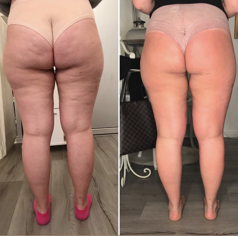 Skockica paket - maderoterapija noge + gluteus - Fabrika ljepote, Sarajevo Anticelulit masaža Masaža Anticelulit masaža, Sarajevo, Istočno Sarajevo