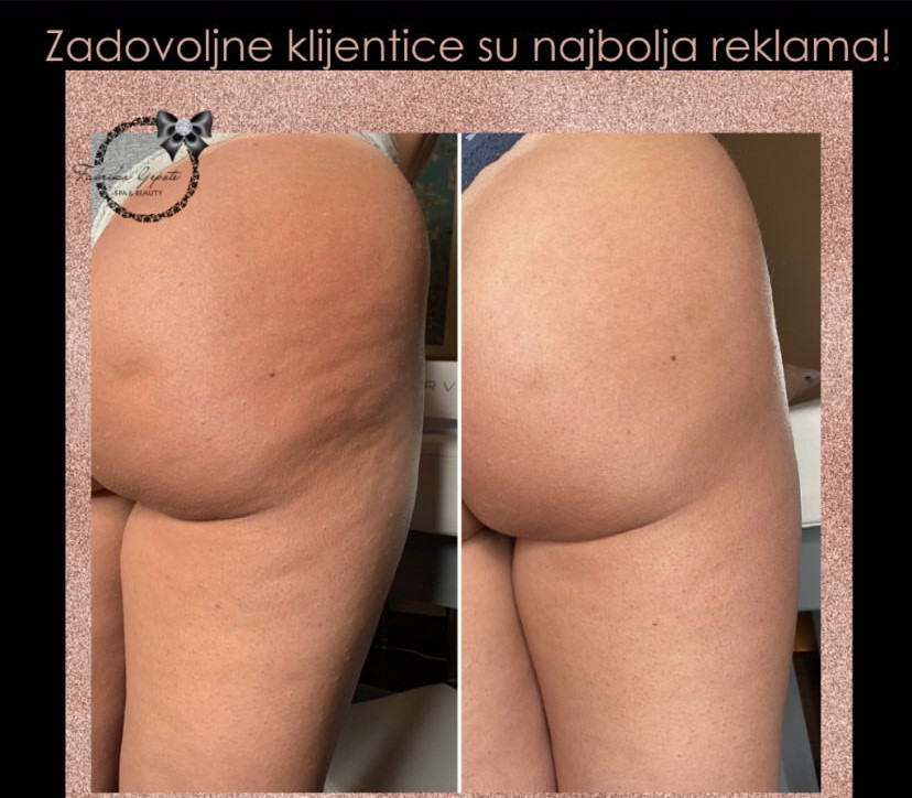 Combo S paket - maderoterapija cijelo tijelo - Fabrika ljepote, Sarajevo Anticelulit masaža Masaža Anticelulit masaža, Sarajevo, Istočno Sarajevo