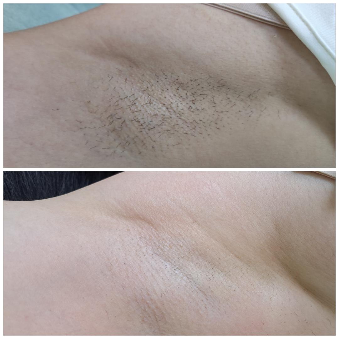 La Piel #mostar Laserska epilacija Epilacija pazuha IPL aparatom - za dame