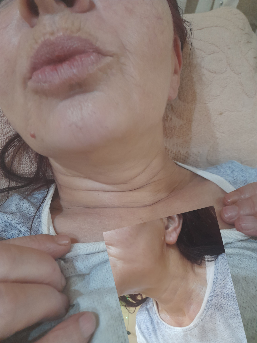 Tretman srebrnim + zlatnim nitima - lice + vrat + dekolte - Poezija ljepote, Sarajevo Tretman lica Lice Tretman lica, Sarajevo, Novo Sarajevo - Novi Grad