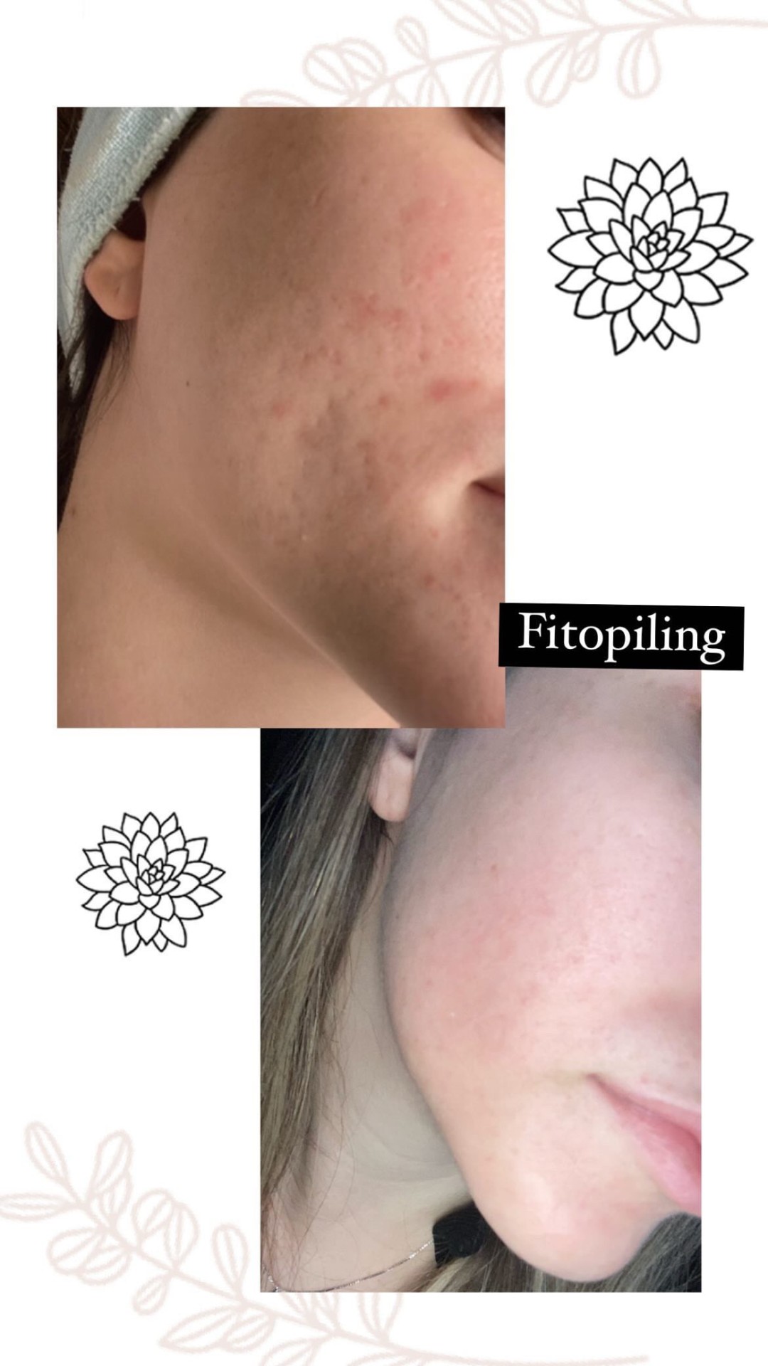 Damen #sarajevo Tretman lica Ultrazvučno čišćenje lica + fitopiling tretman lica