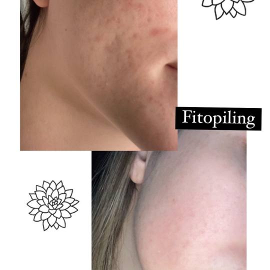 Damen #sarajevo Tretman lica Ultrazvučno čišćenje lica + fitopiling tretman lica Efekat nakon fi