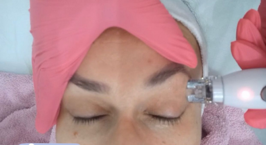 Laser Beauty Studio #visoko Tretman lica Zatezanje kože i redukcija masnih naslaga - lice