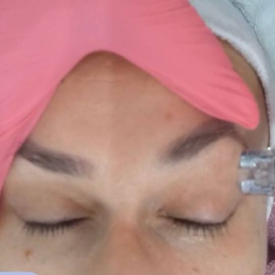 Laser Beauty Studio #visoko Tretman lica Zatezanje kože i redukcija masnih naslaga - lice