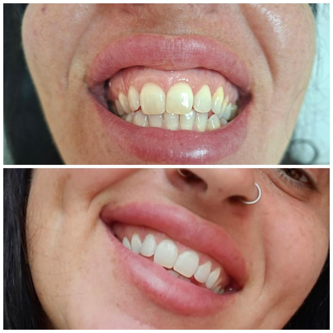 Lasersko izbjeljivanje zuba - 3 sesije - La Piel, Mostar Tretmani tijela Tijelo Tretmani tijela, Mostar, Centar