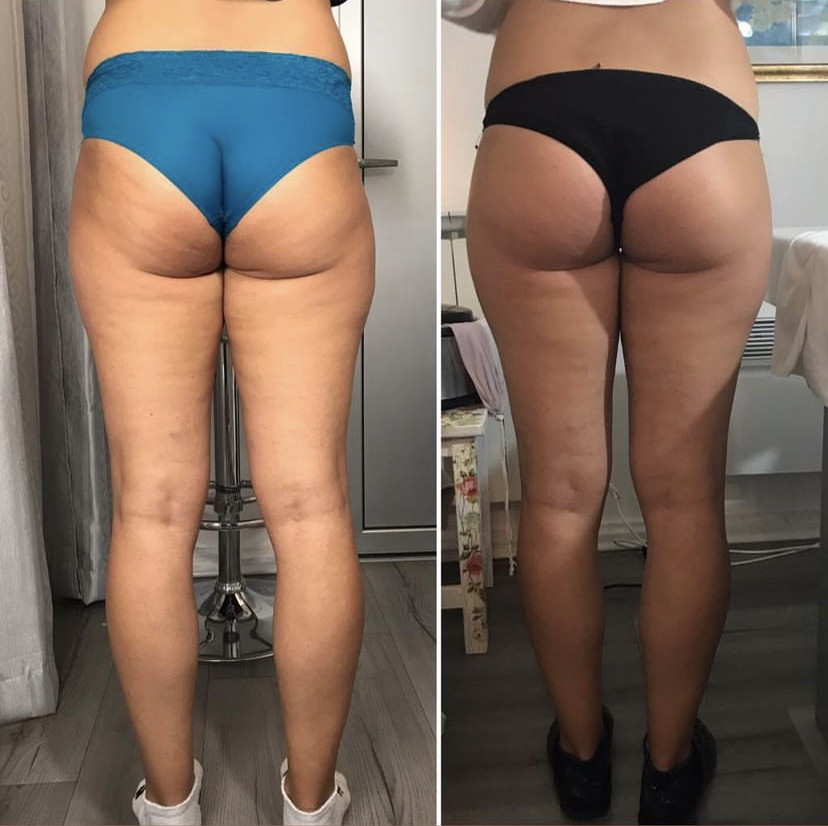 Skockica paket - maderoterapija cijelo tijelo - Fabrika ljepote, Sarajevo Anticelulit masaža Masaža Anticelulit masaža, Sarajevo, Istočno Sarajevo