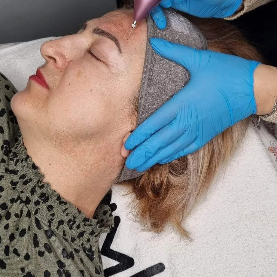 Plazma pen - celog lica - Poezija ljepote, Sarajevo Tretman lica Lice Tretman lica, Sarajevo, Novo Sarajevo - Novi Grad