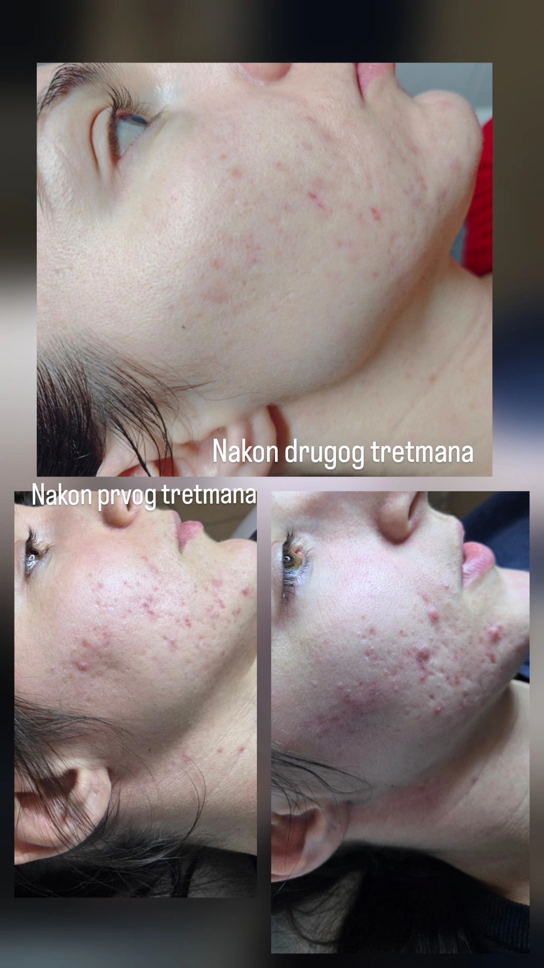 Angels Beauty - Banja Luka #banjaluka Tretman lica Higijenski tretman ultrazvučnom špatulom + komedoekpresija