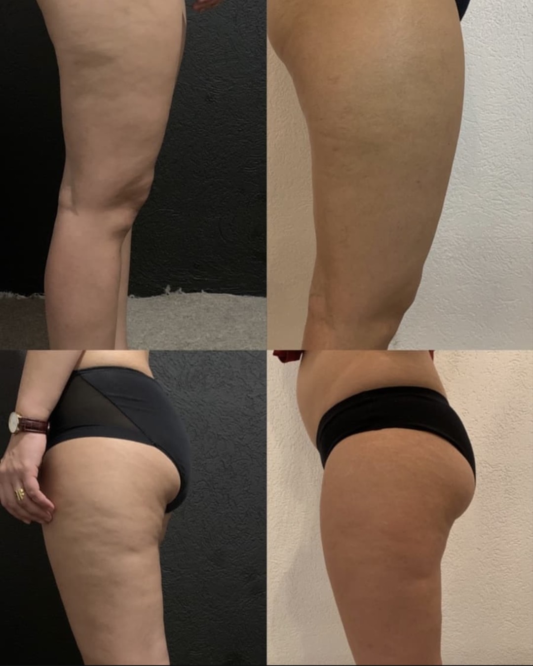 Damen #sarajevo Anticelulit masaža Maderoterapija - noge + gluteus