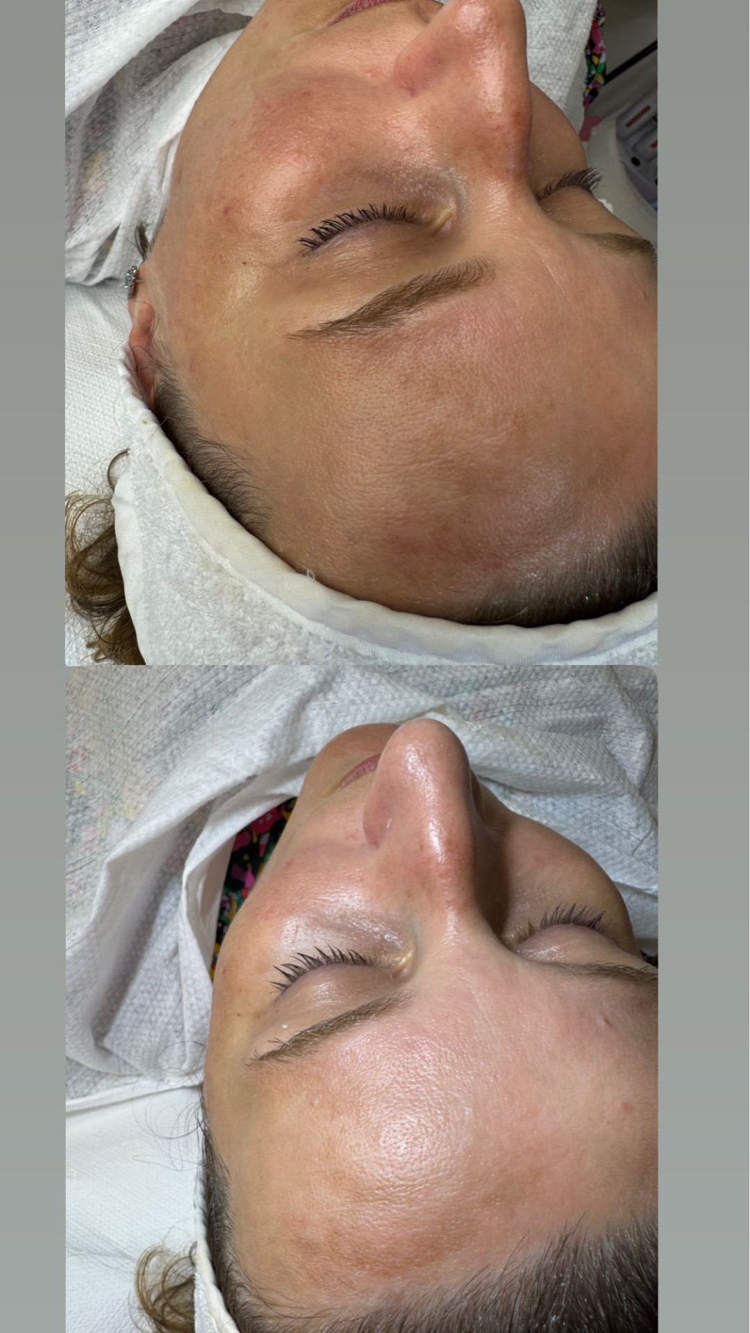 Fridem #banjaluka Tretman lica Microneedling lica