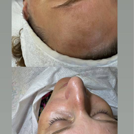 Fridem #banjaluka Tretman lica Microneedling lica