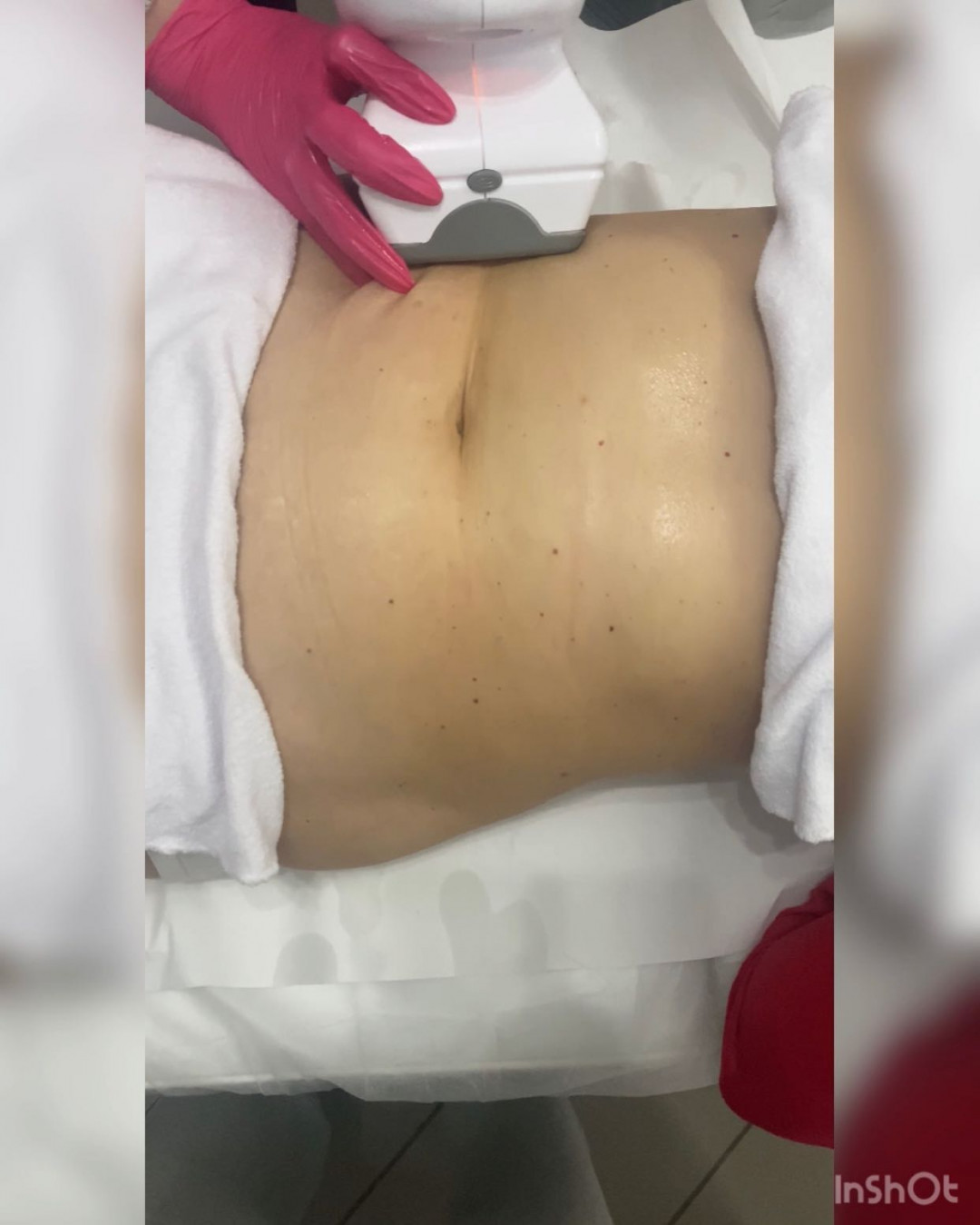 Laser Beauty Studio #visoko Tretman lica Zatezanje kože i redukcija masnih naslaga - stomak